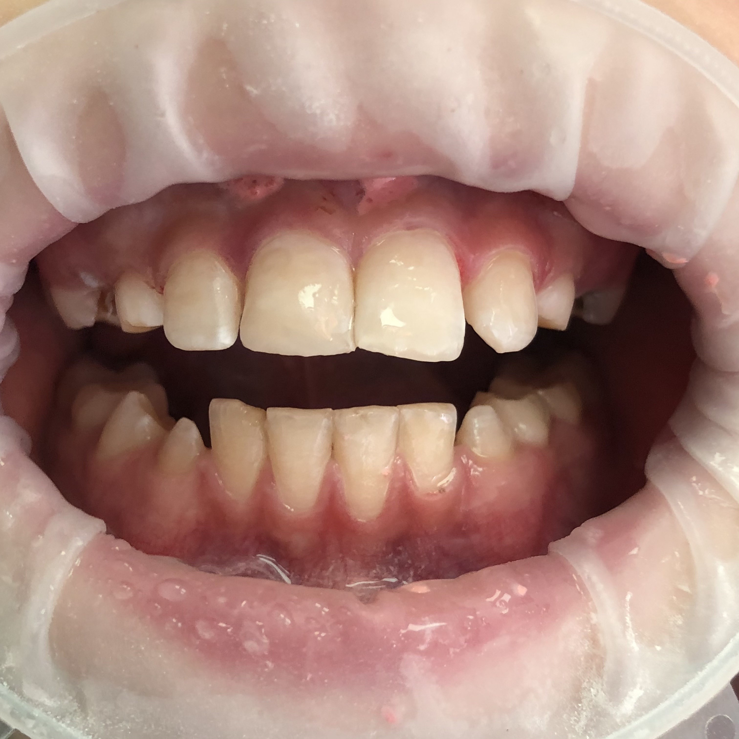 Яковлева реставрация передних зубов
