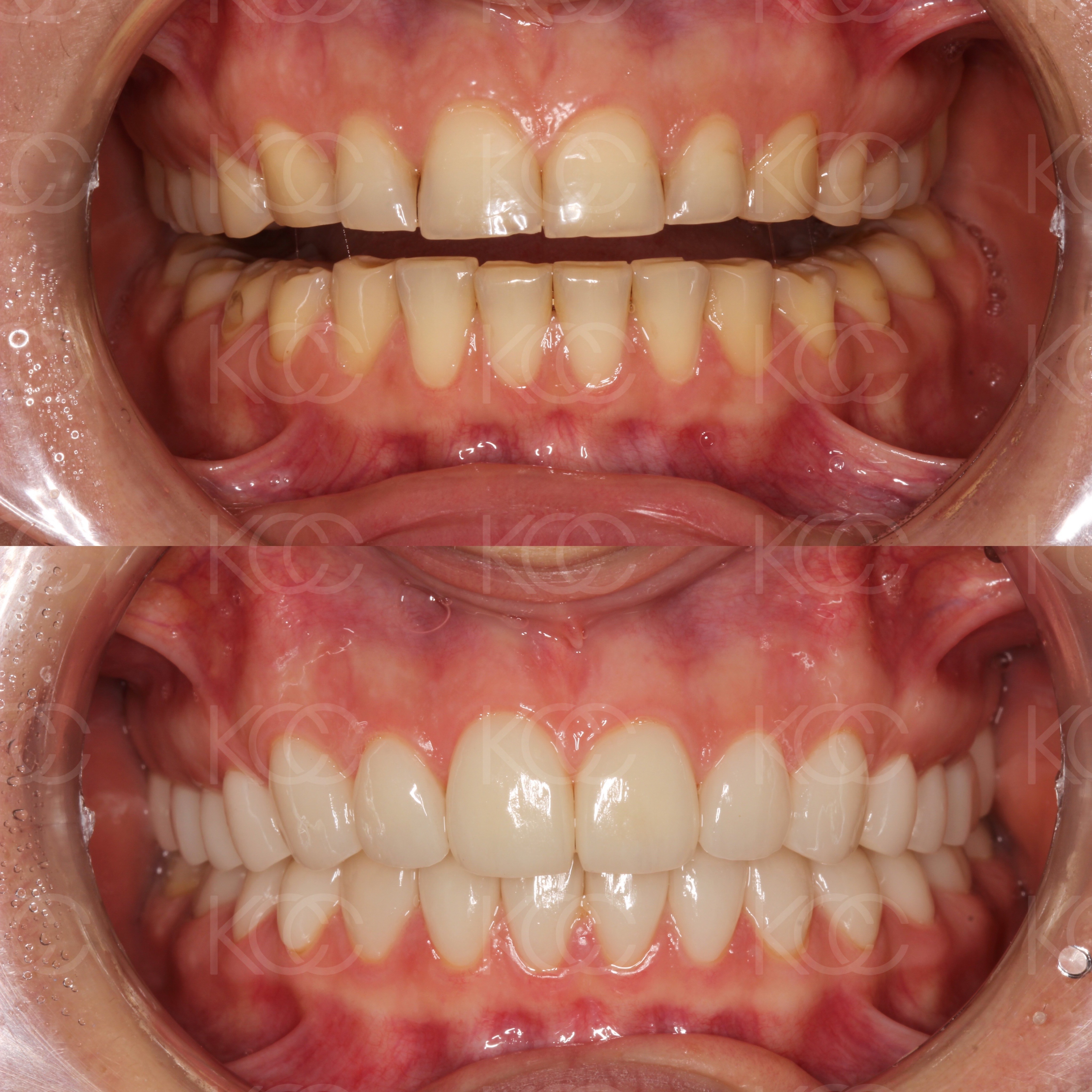 Восстановление анатомии зубов винирами, с изменением положения нижней челюсти