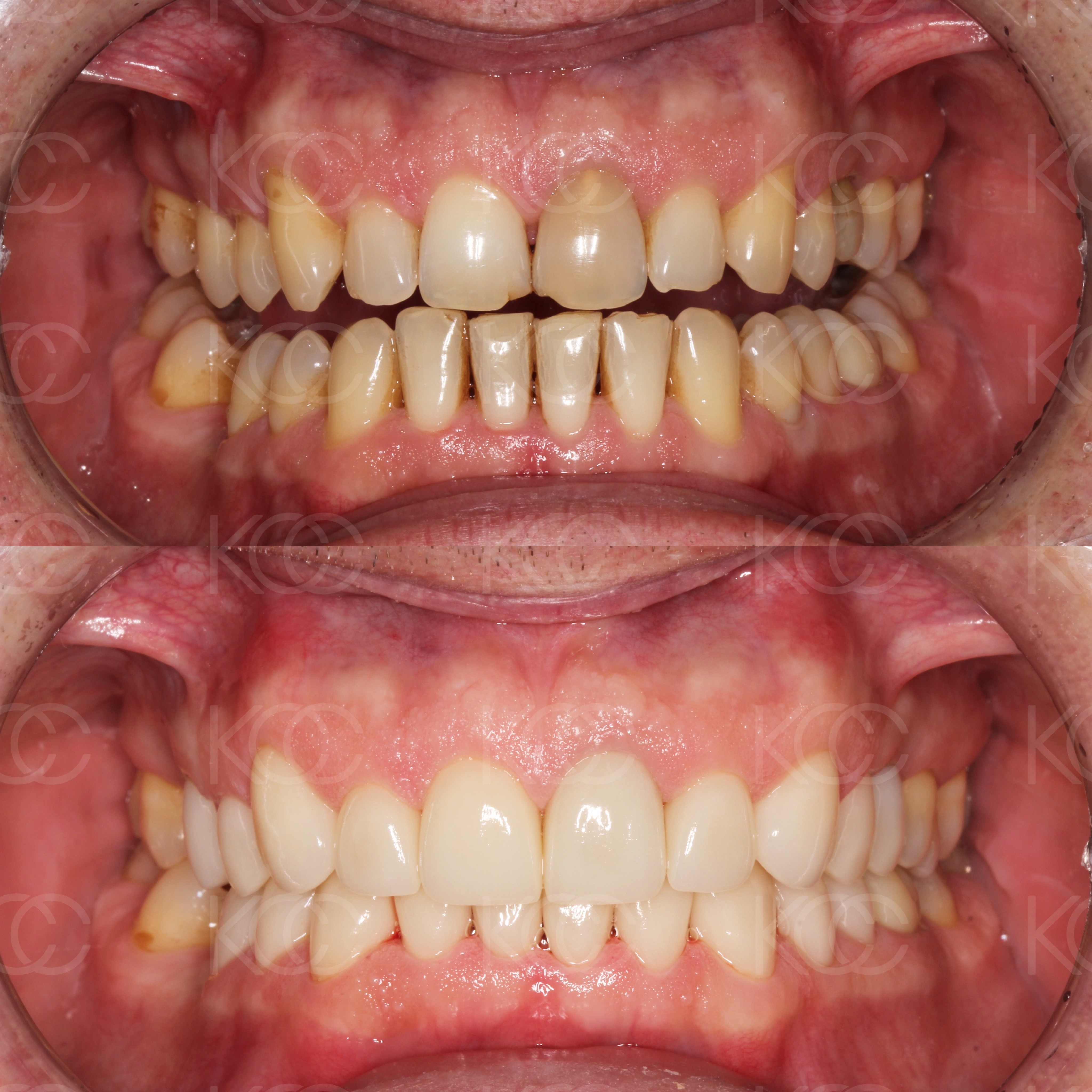 Восстановление 20 зубов винирами 15 25 и 35 45 зубы Цвет В1