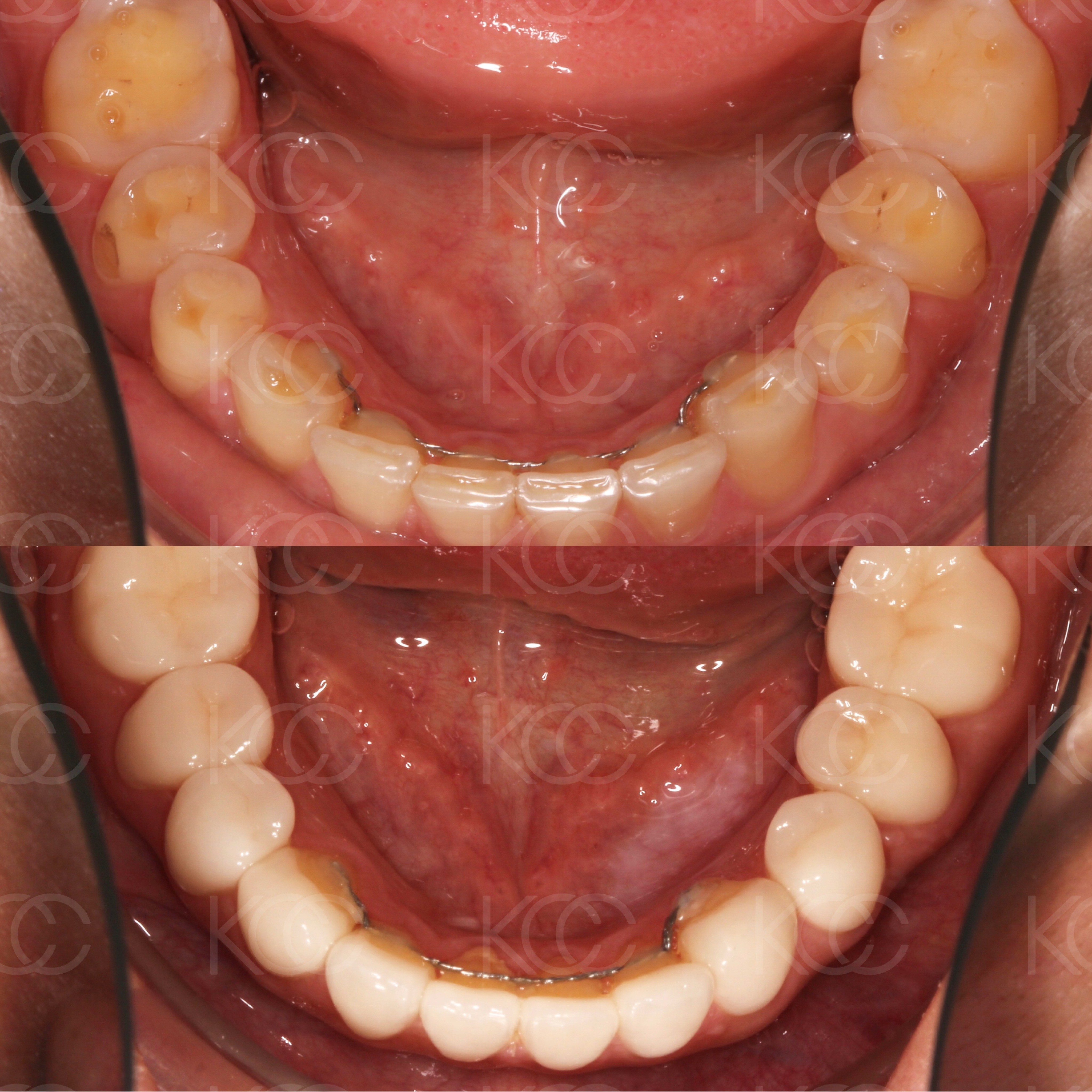 Протезирование всех зубов после ортодонтической подготовки